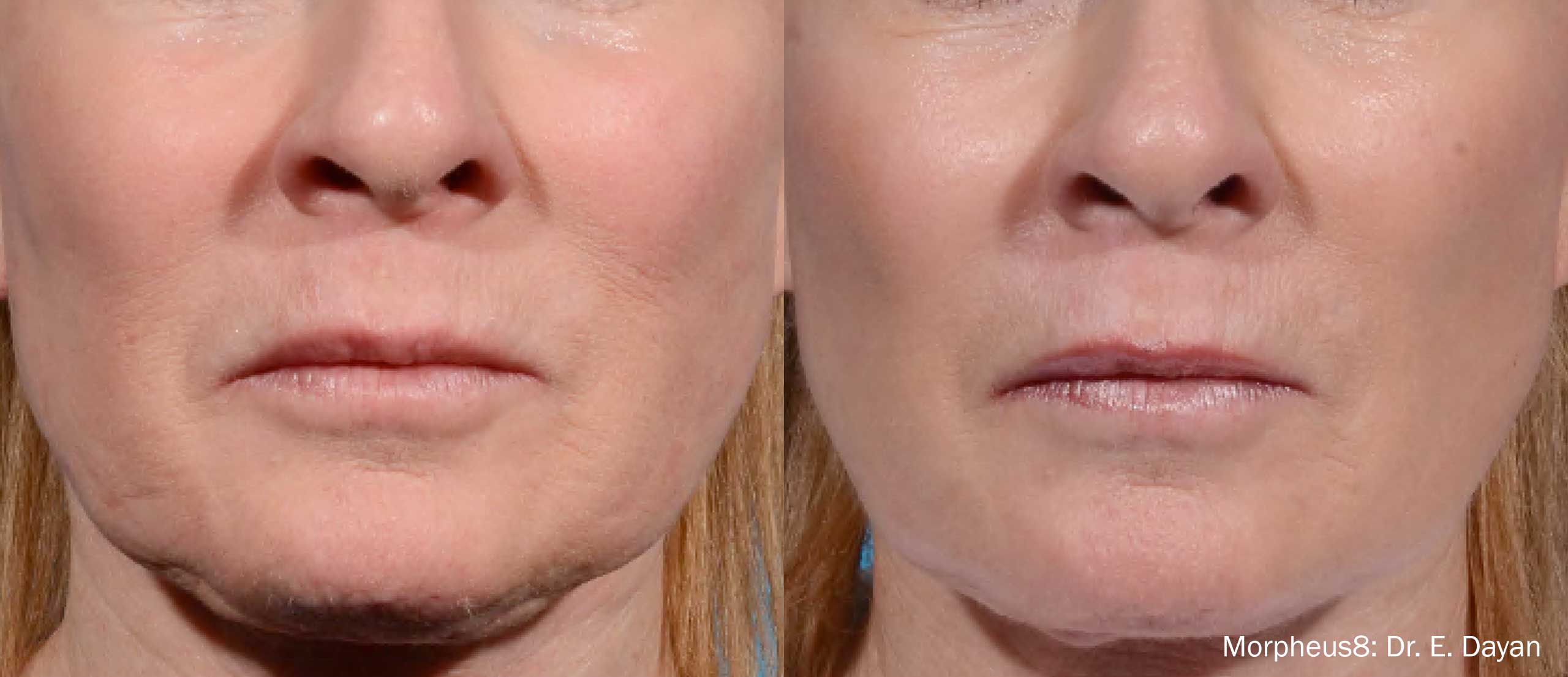 skin tightening with morpheus8 results