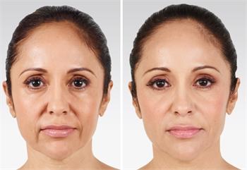 anti-aging before and after results from dermal filler injections in Millburn, NJ