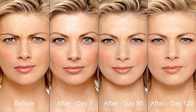 Botox wrinkle reduction treatment results in Millburn
